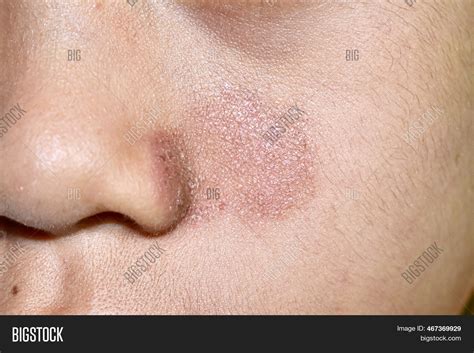 tinea faciei fungal image photo  trial bigstock