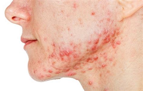 What are different types of acne - symptoms, causes and treatment