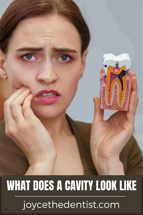 Oral thrush – Artofit