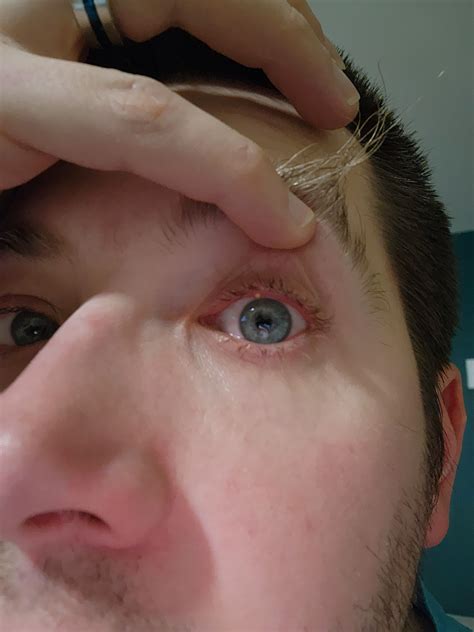 Lump Inside Upper Eyelid