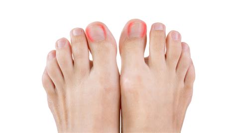 how to treat infected ingrown toenail at home