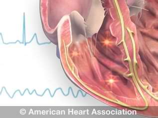 Heart Conduction Disorders | American Heart Association