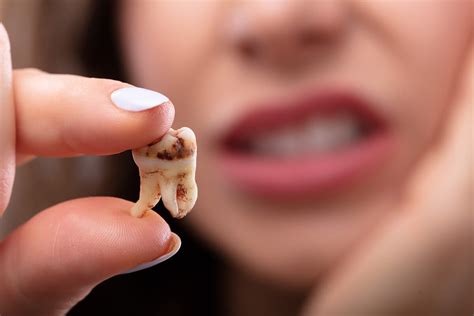 O Que E Sonhar Com Dente Podre - Sonhar com Dentes Podres Significados Espirituais