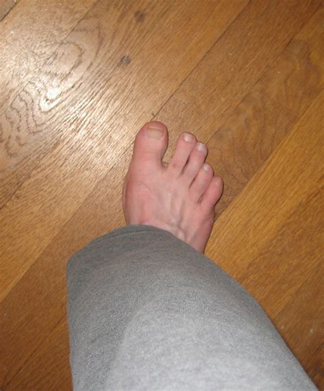 My Happy Stroke: Mysteries of Stroke