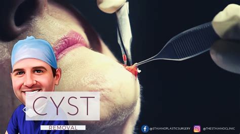 Cyst Removal [LIVE SURGERY] Before and After - YouTube