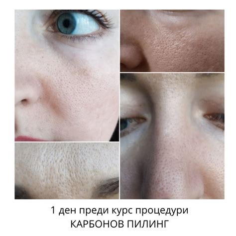Карбонов Лазерен Пилинг - Приятел в борбата срещу акнето, разширените ...