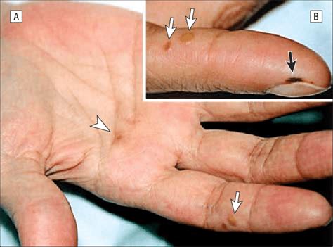 Janeway Lesions