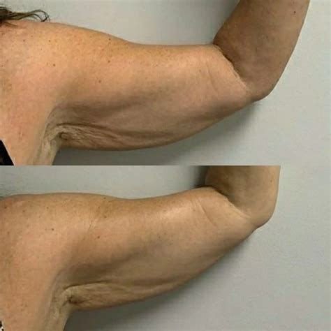 Braço Flácido Antes E Depois - Tratamento para Gordura Localizada Antes e Depois