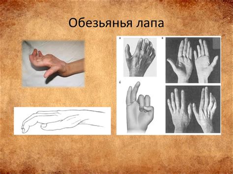 Наследственная нейропатия Шарко-Мари-Тута - презентация онлайн