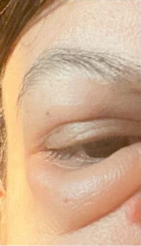 patient reported   week history  intermittent