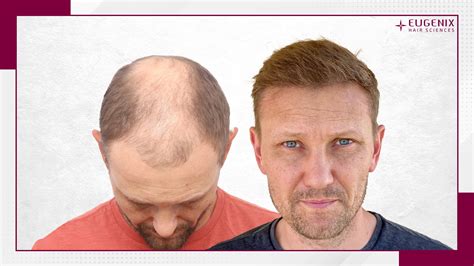 Hair Transplant Before and After | Hair Transplant Results