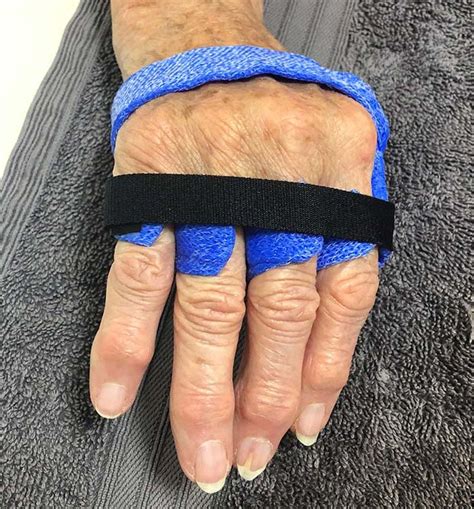 splinting supports sa hand therapy