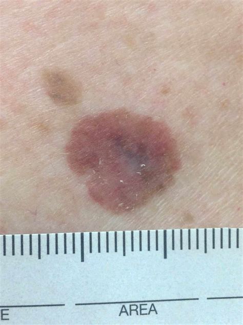 Byford Skin Cancer Clinic | Byford Skin Cancer Clinic