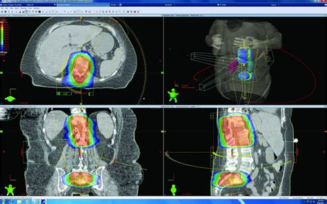 varian eclipse treatment planning system treatment planningguidance