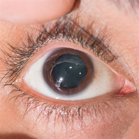 Mydriasis: Why Are My Pupils Dilated and What Should I Do?