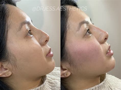 surgical rhinoplasty dr jess aesthetics