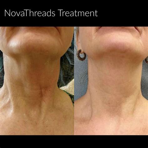 botox for neck line 4
