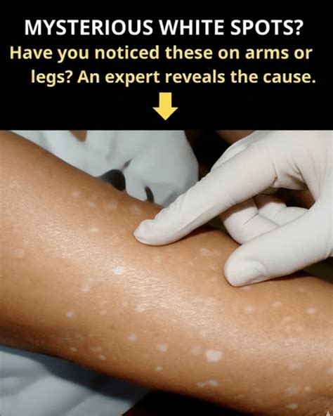 Die kleinen weißen Flecken an Armen und Beinen sind nicht einfach nur