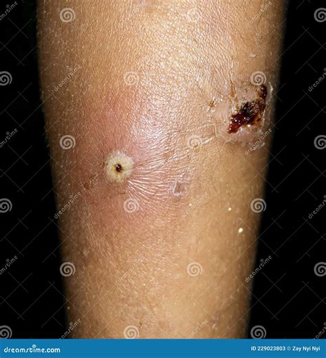 Furuncles or Staphylococcal Infection in Leg of Asian Child Stock Image