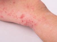 Skin Allergy - Skin Allergy Treatments