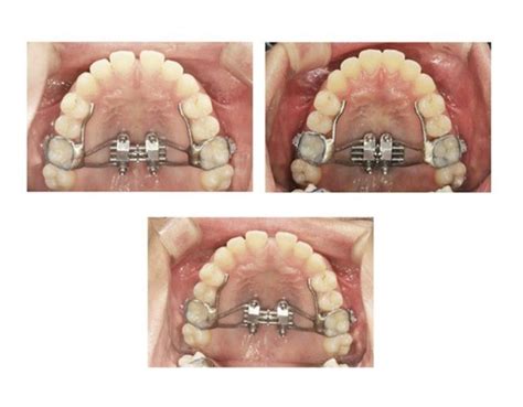 Maxillary Skeletal Expansion (MSE) | Dentist Arlington, VA