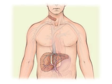 transjugular intrahepatic portosystemic shunt tips
