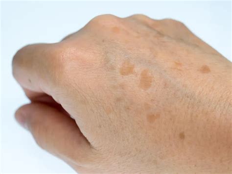 Age spots - First Health Medical and Skincare