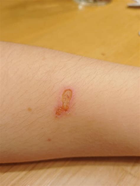 burn wound infected rmedical