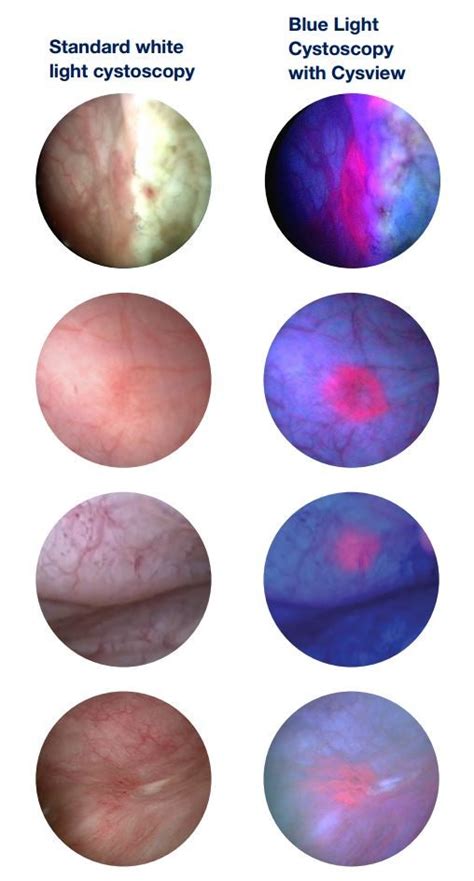 blue light cystoscopy unc department  urology