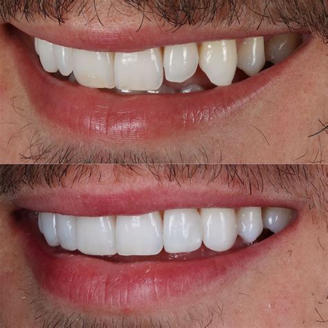 Composite Resin Bonding | Helix Dental Mermaid Water