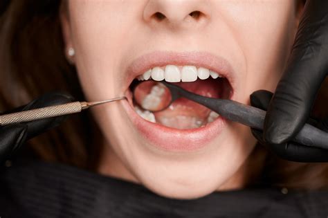 Гранулом: причини, симптоми и лечение - Marinova Dental Clinic