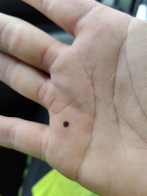 Blood Blister On Finger Cause at Alex Cruz blog