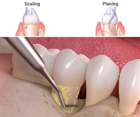 Deep Teeth Cleaning