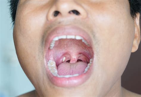 White Spots On Tonsils