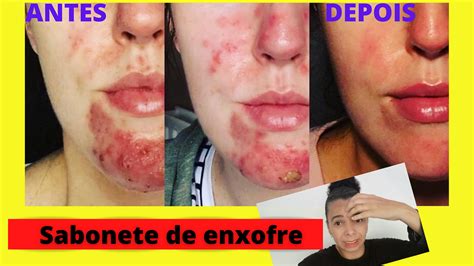 Enxofre É Bom Para Que - Sabonete de enxofre-sabonete de enxofre para que serve-sabonete de ...