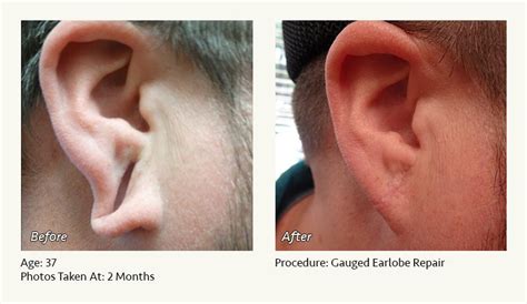 Earlobe Surgery in Plano & Dallas, TX | Ronald Friedman, M.D.