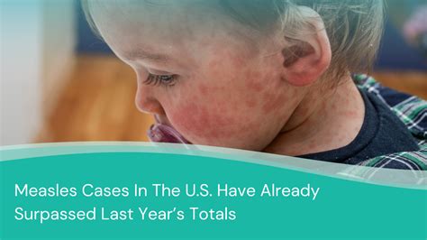 measles cases   rise    jase medical