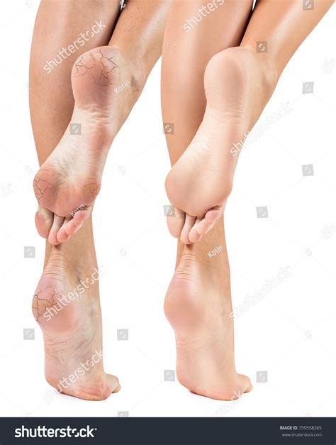 153 Itching Women Before After Images, Stock Photos & Vectors