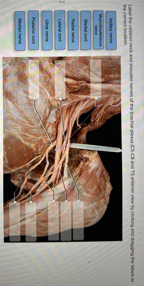 Solved Label the cadaver neck and shoulder nerves of the | Chegg.com
