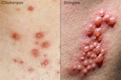 Chickenpox