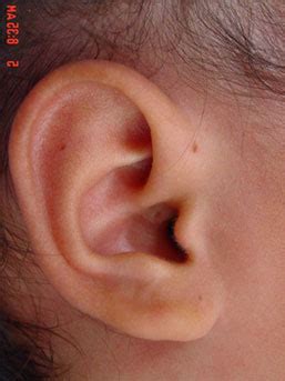 Preauricular Cysts and Ear Cysts – ENT 4 kids