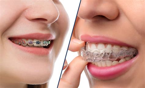 clear braces  pros  cons  invisible aligners