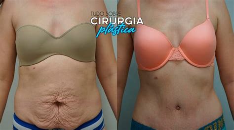 Como Fica A Barriga Depois Da Abdominoplastia - Abdominoplastia Antes e Depois com Fotos em 2026 - TS Cirurg. Plástica
