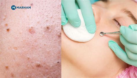 Unbelievable Blackhead Removal 2024: Get Clear Skin FAST! - 9oqtrle