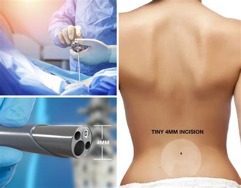 Minimally Invasive Spine Surgery | North American Spine & Pain Institute