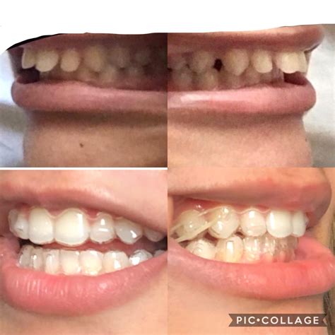 Overbite Y Overjet 7