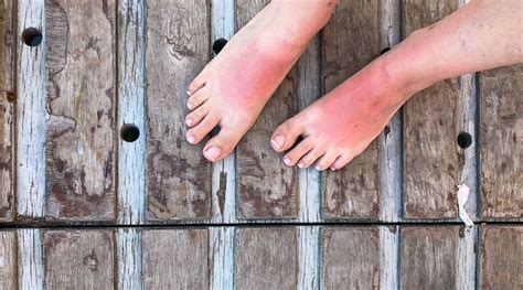 sun poisoning  symptoms  treatment