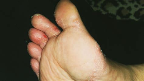 Frieira Entre Os Dedos Do Pé - Tinea pedis - descubra o que é e como tratar a frieira/pé de atleta ...
