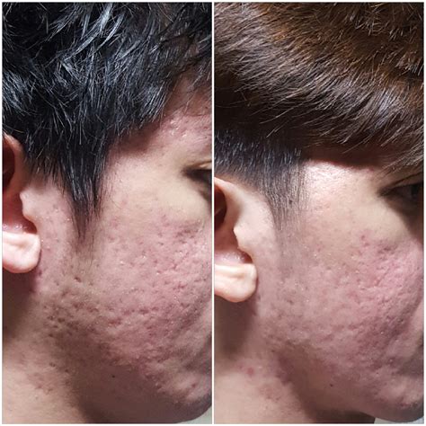 AFRAID OF TCA CROSS – Acne Scars – Acne.org Forum