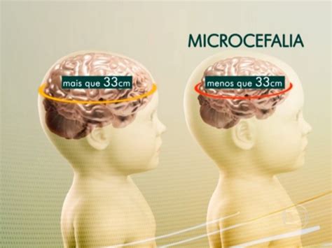 O'que É Microcefalia - TOP NOTÍCIAS: Microcefalia: saiba o que é, o que causa e como identificar